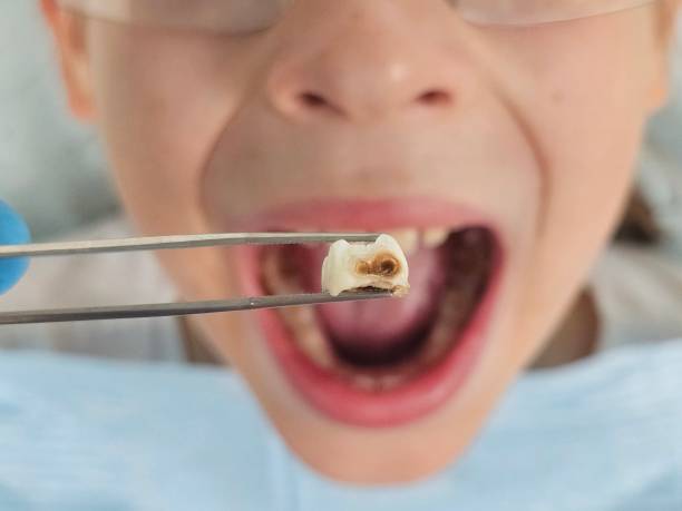 Best Emergency Treatment for Toothache in New Hackensack, NY